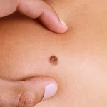 Metastatic Melanoma: Symptoms, Stages, Treatment